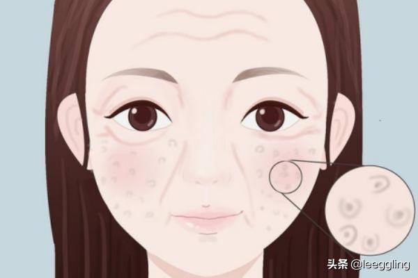 三种类型的毛孔（三种类型的毛孔对比）